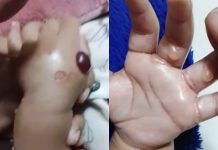 Diduga Perawat RSUD Dr Soewandi Salah Suntik Infus, Tangan Bayi Melepuh dan Bengkak